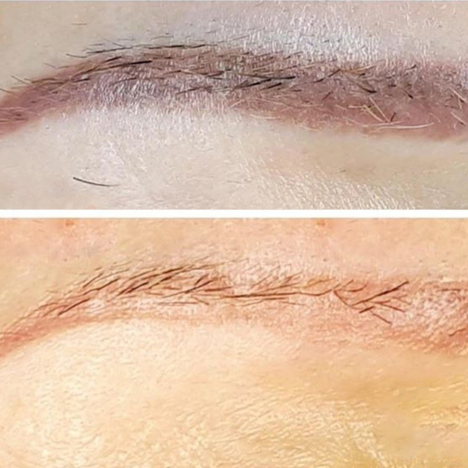 PMU Removal