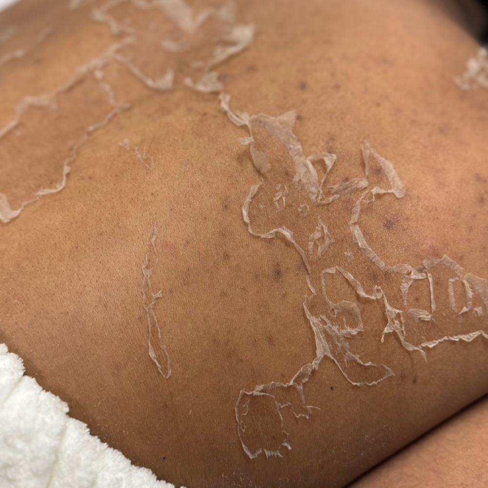 Body Chemical Peel at Au Naturale Luxe in York, PA