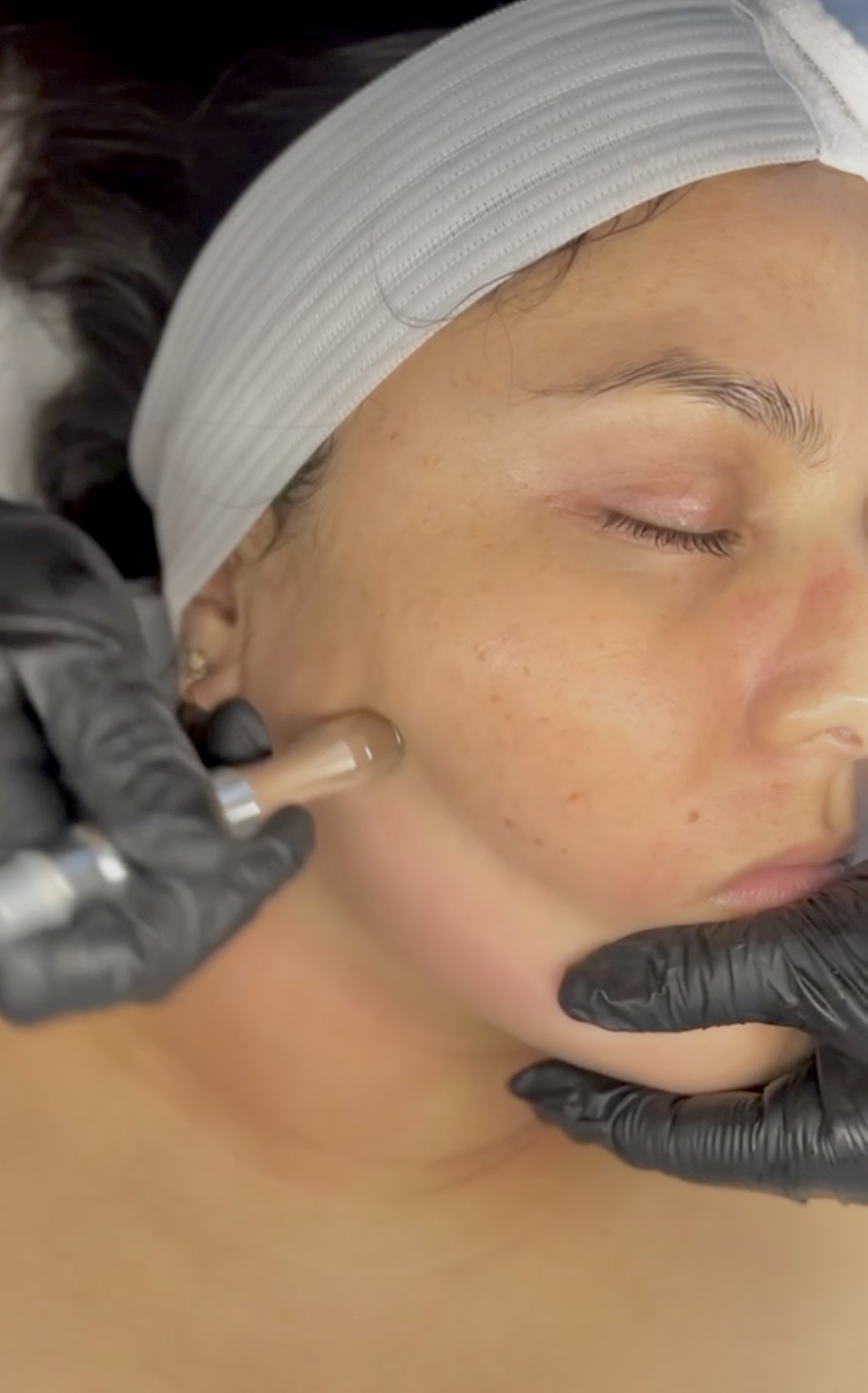 Microdermabrasion