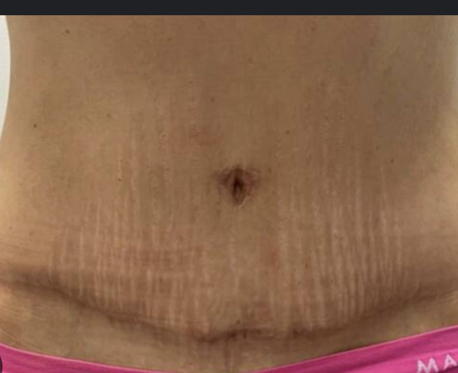 FIBROBLAST STRETCH MARK REMOVAL