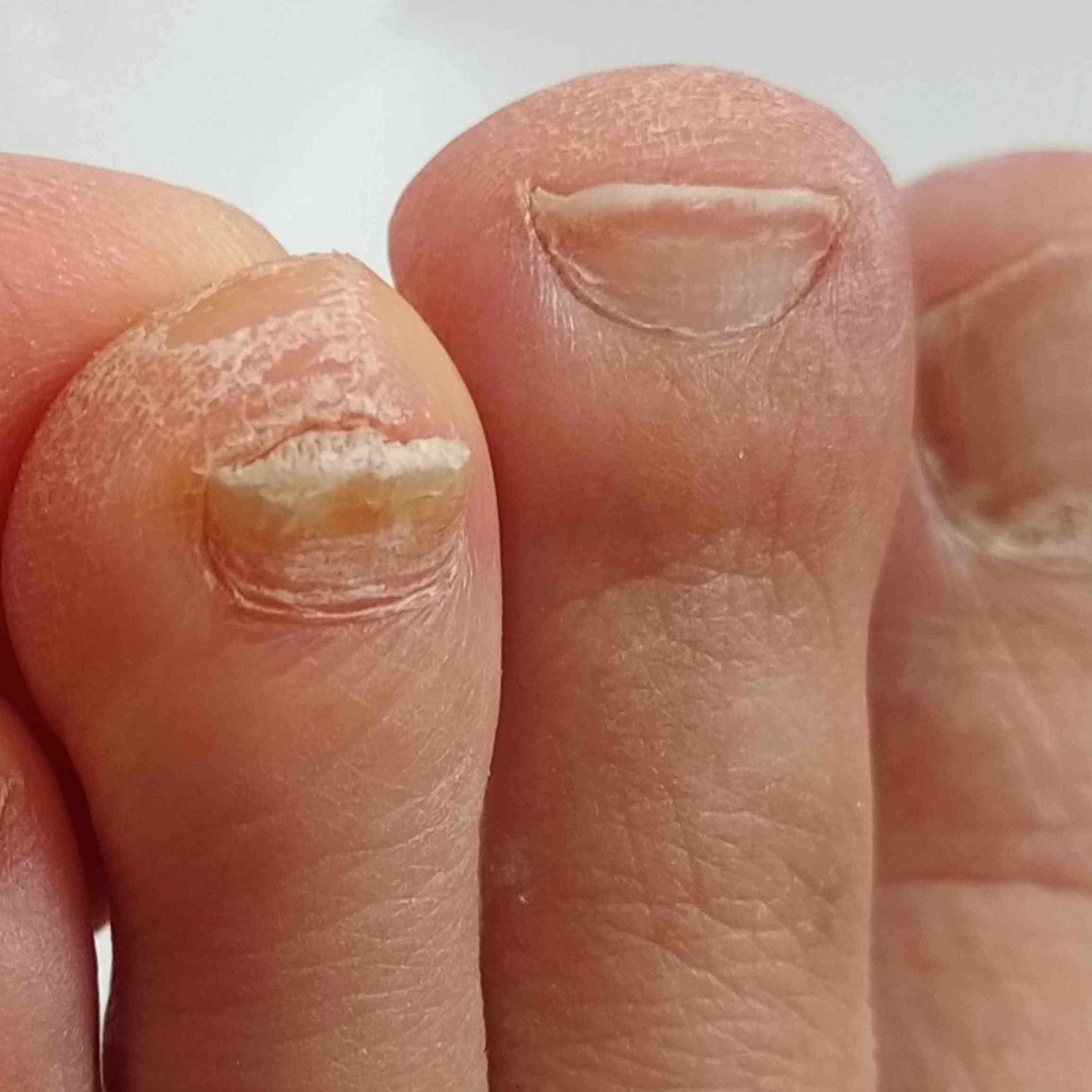 STAGE I- RN- Medical Pedicure