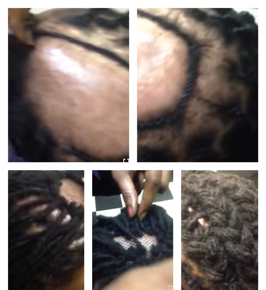 Alopecia Hair Loss Loc Install