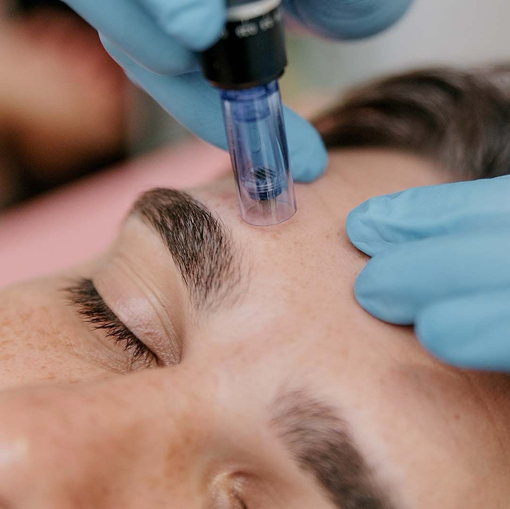 Microneedling at Vanessa Yarce in Miami, FL