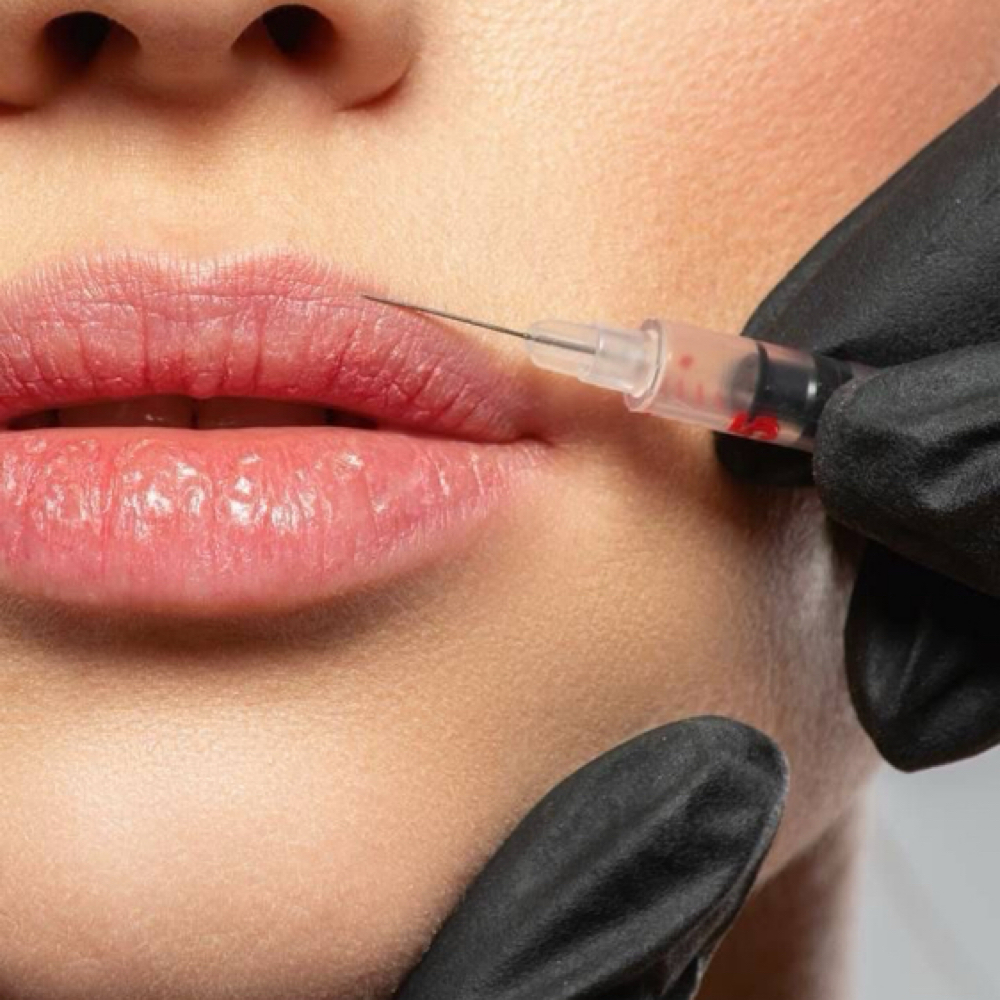 Lip Filler-Full Syringe at Southern Luxe Aesthetics in Livingston, TX