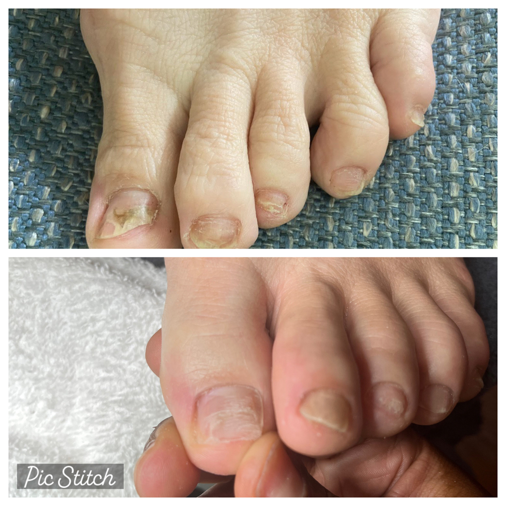 Toe Nail Restoration
