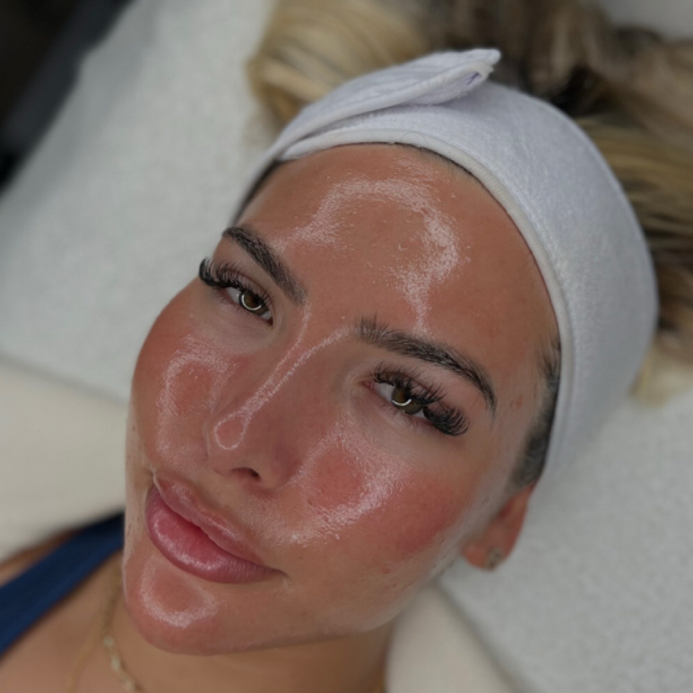 No-needle CO₂ carboxytherapy at Embassy&health&beauty in Hallandale, FL