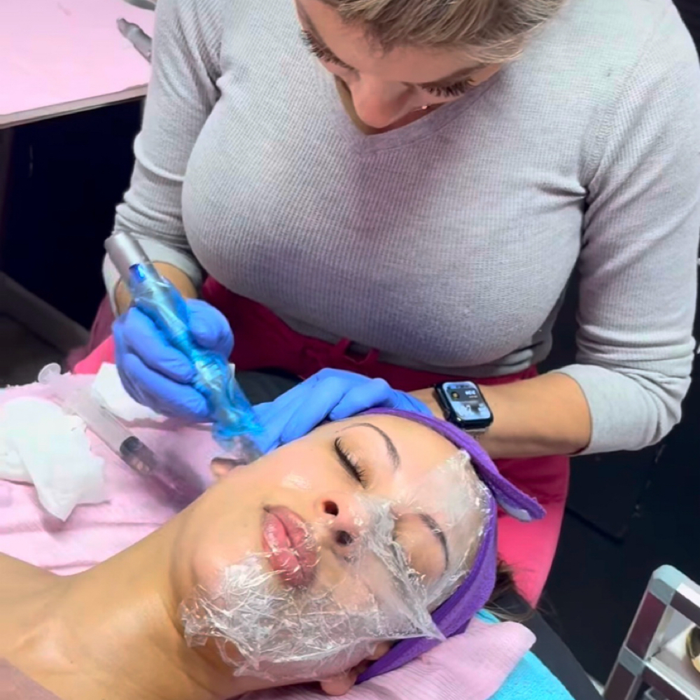 Nanoneedling at Bliss Med Spa in Riverside, IL