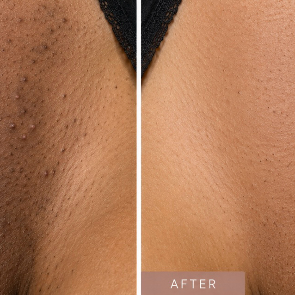 Brazilian Area Facial Treatment at Studio Glow Esthetics By Ashten in Coshocton, OH