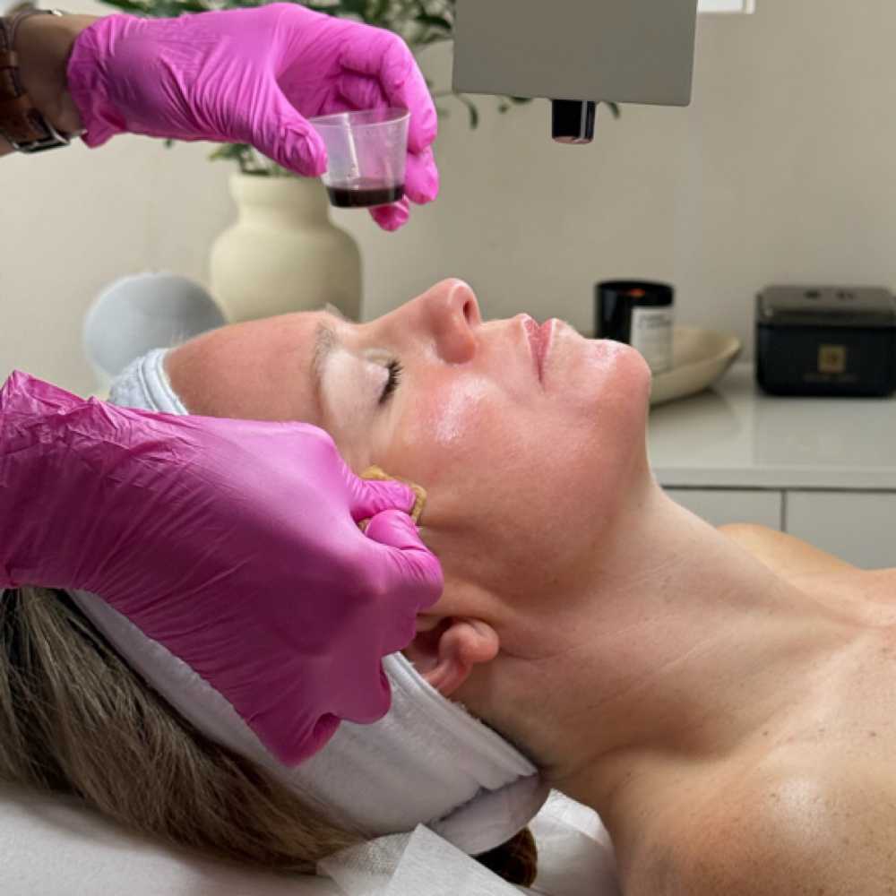 VI Peel at DermAdi Skin in Houston, TX
