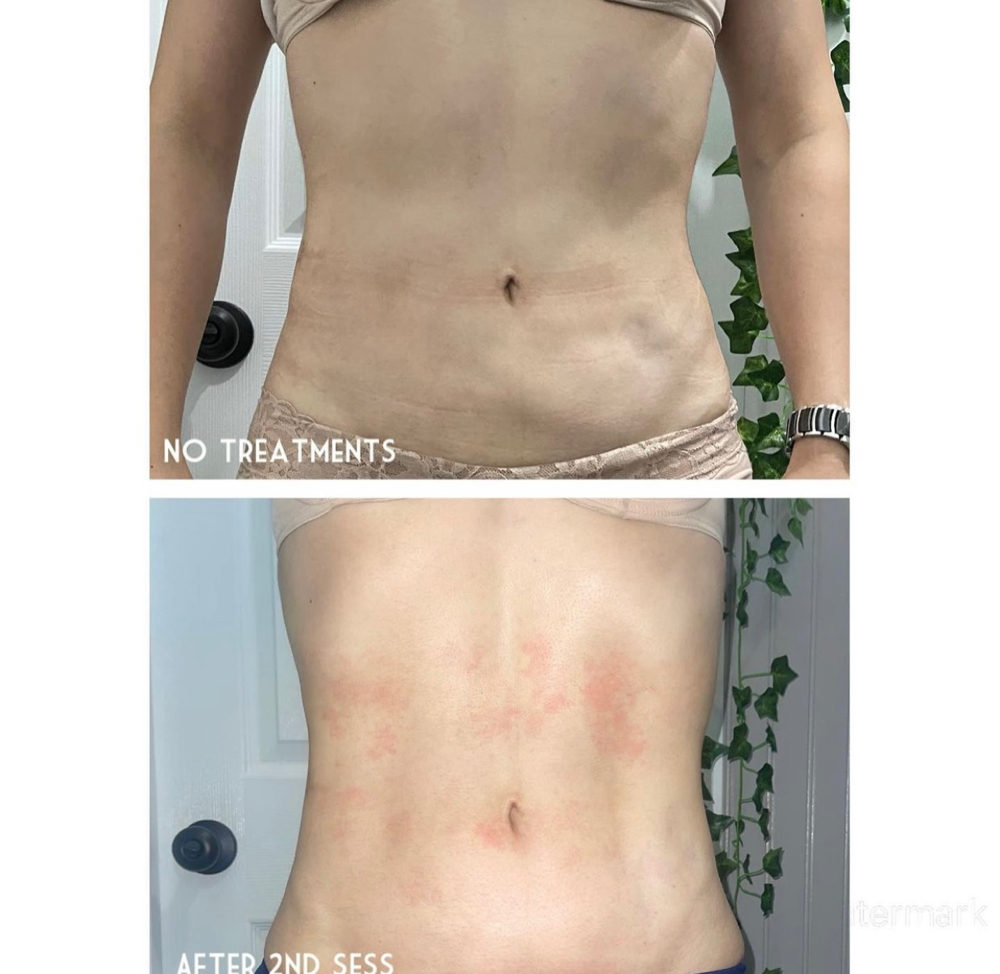 Fibrosis Treatment