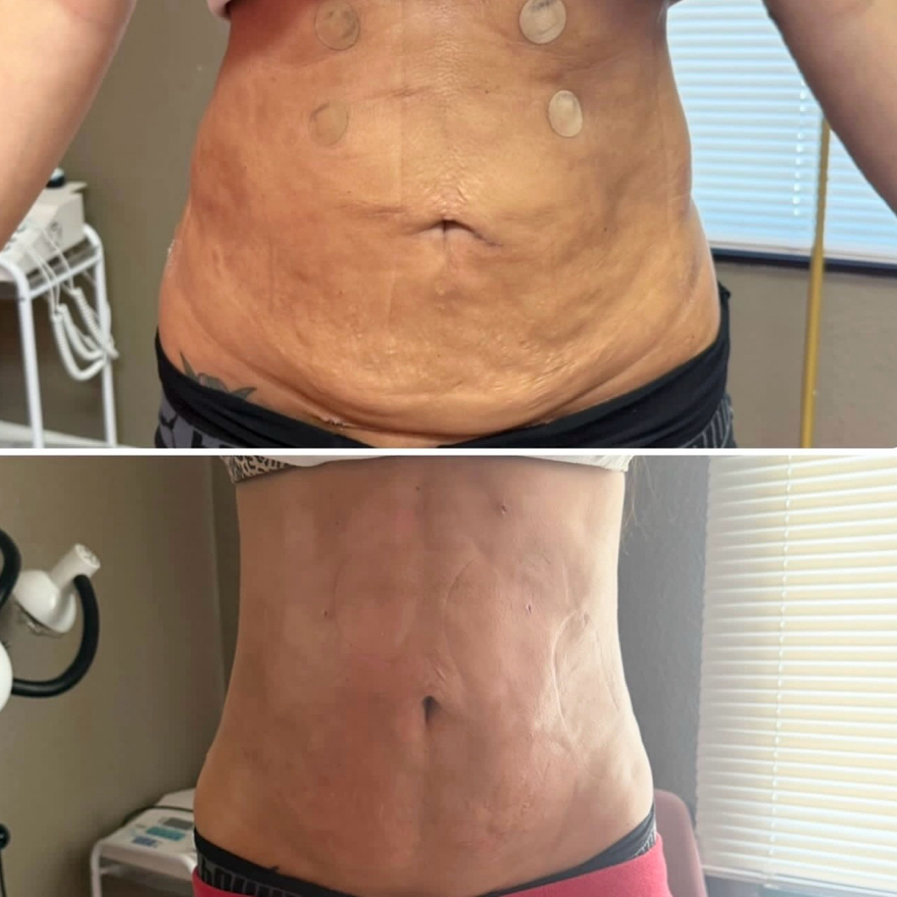 Fibrosis Treatment at Self Love Aesthetics in Corning, CA