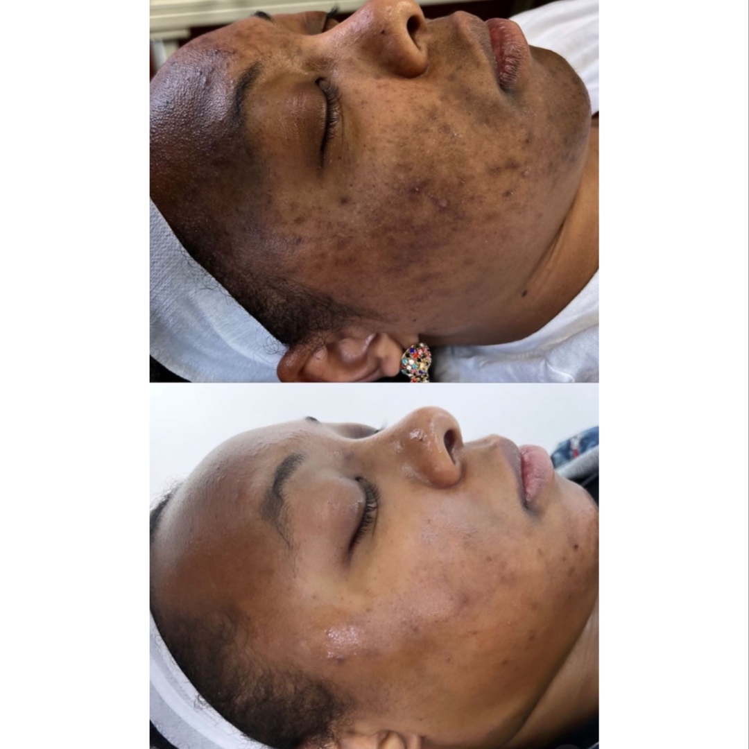 PEEL LEVEL 3 (Medical Grade Peel) at FIRMÉ SKIN in Columbia, MD