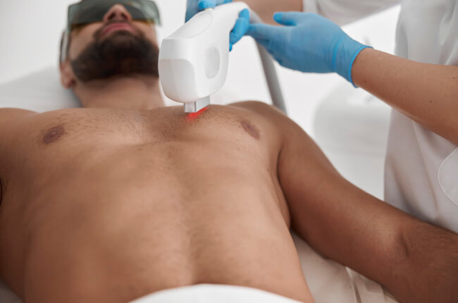 Laser Hair Removal: Chest