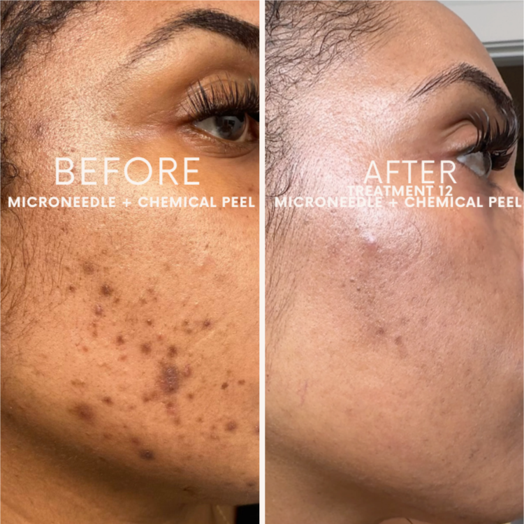 Corrective Microneedling Series at Glow Aesthetics Studio in Atlanta, GA