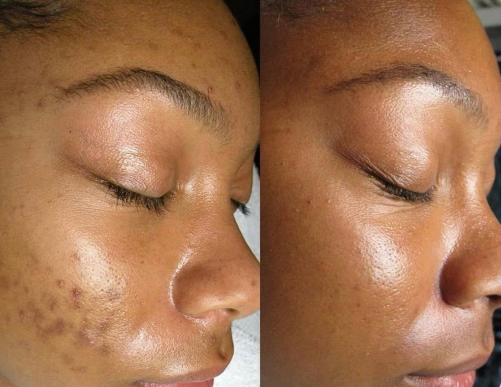 Microneedling Facial Add On