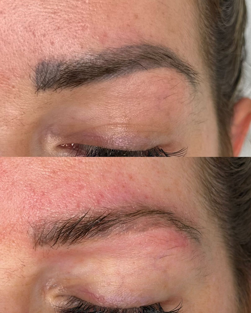 LASER TATTOO REMOVAL