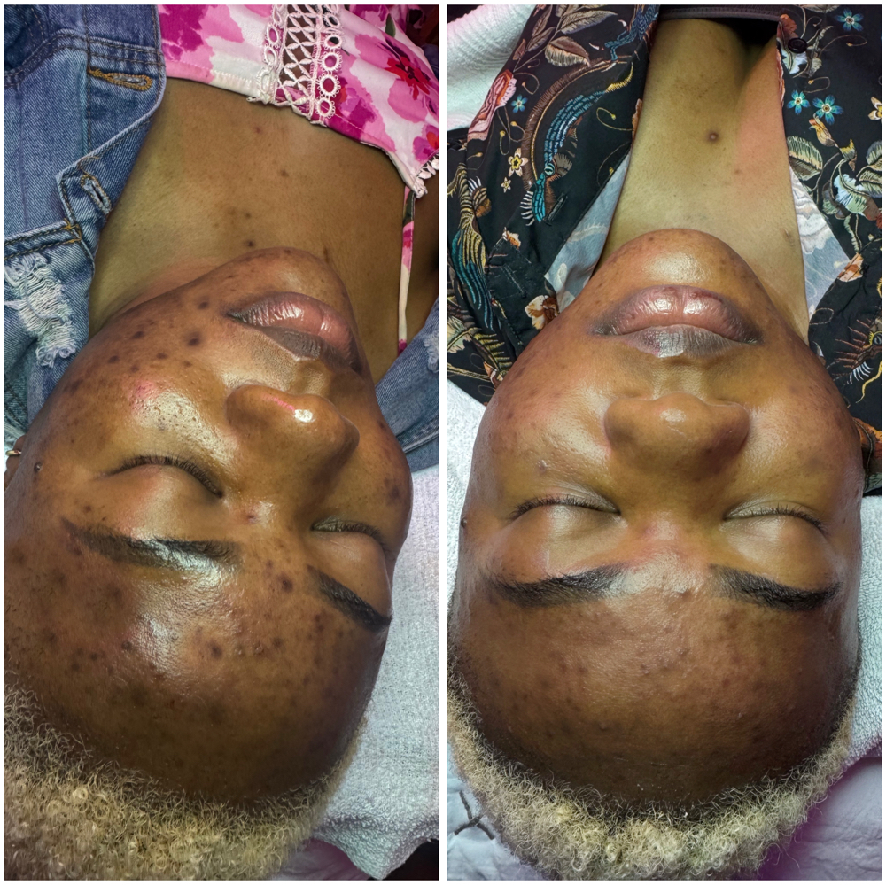 Pigment Lift Peel (Medium-Depth