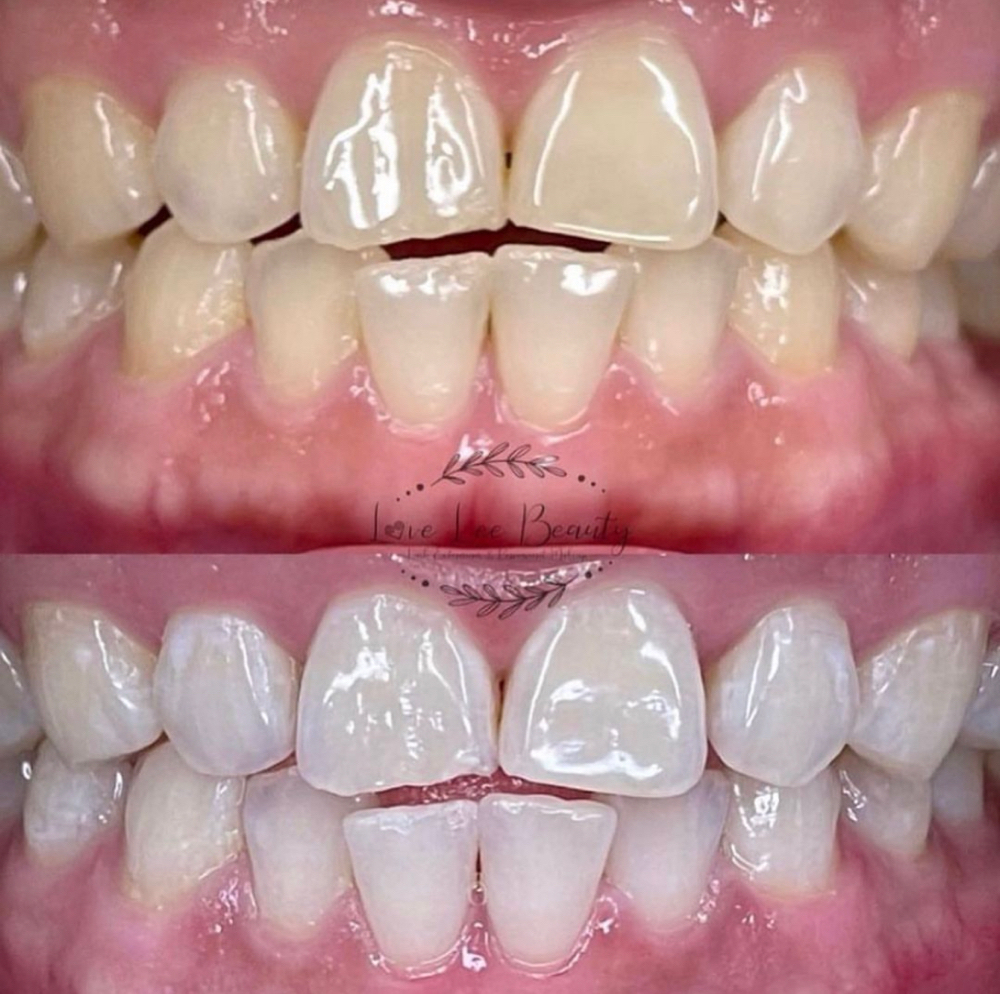 RETURNING Teeth Whitening Clients