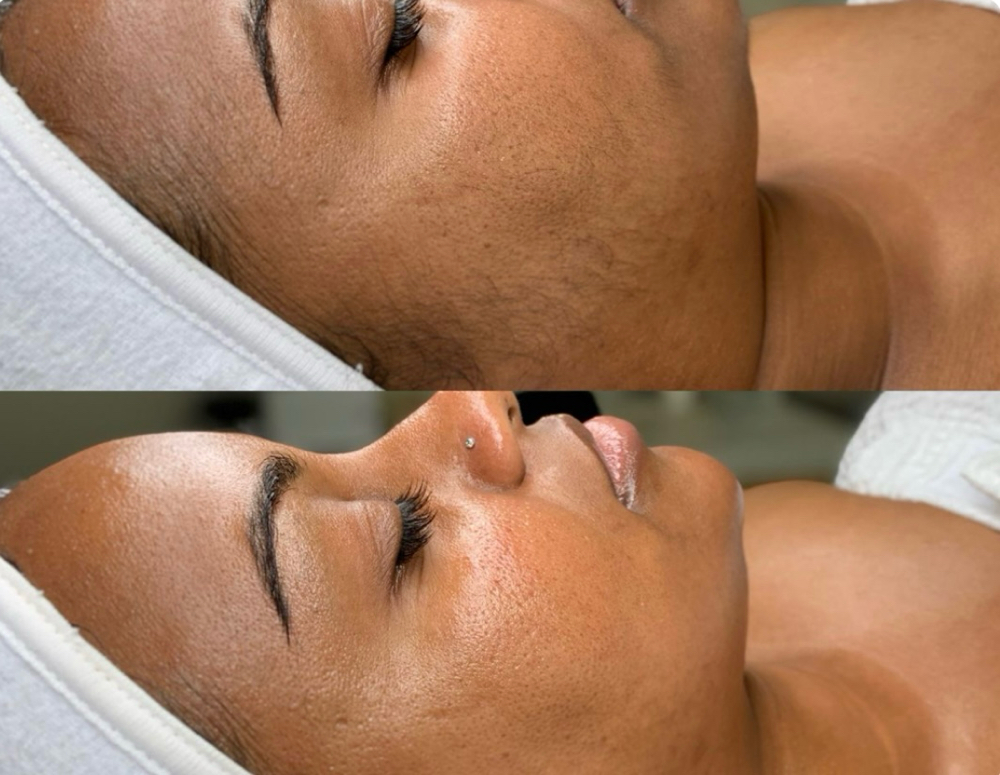 DERMAPLANING FACIAL