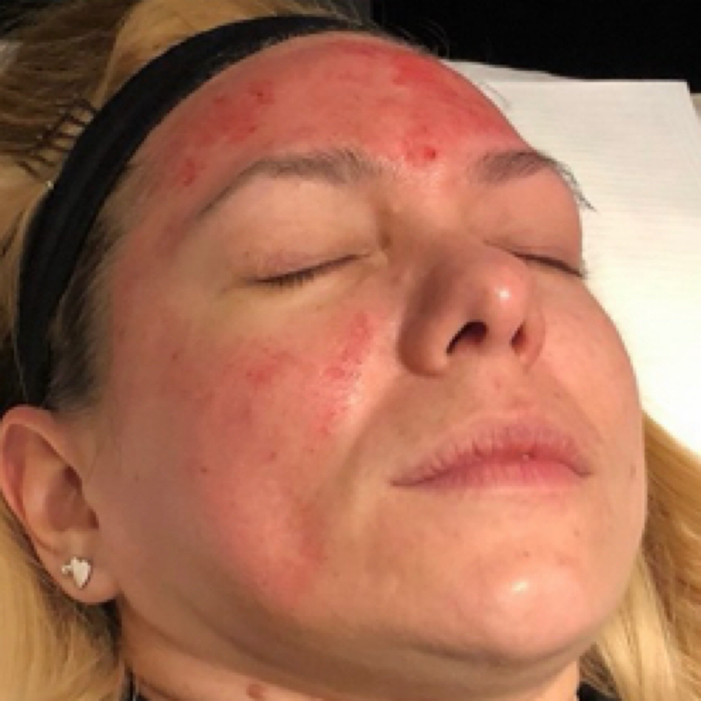 Vampire Facial at Zen Essence Spa & Wellness in Brooklyn, NY