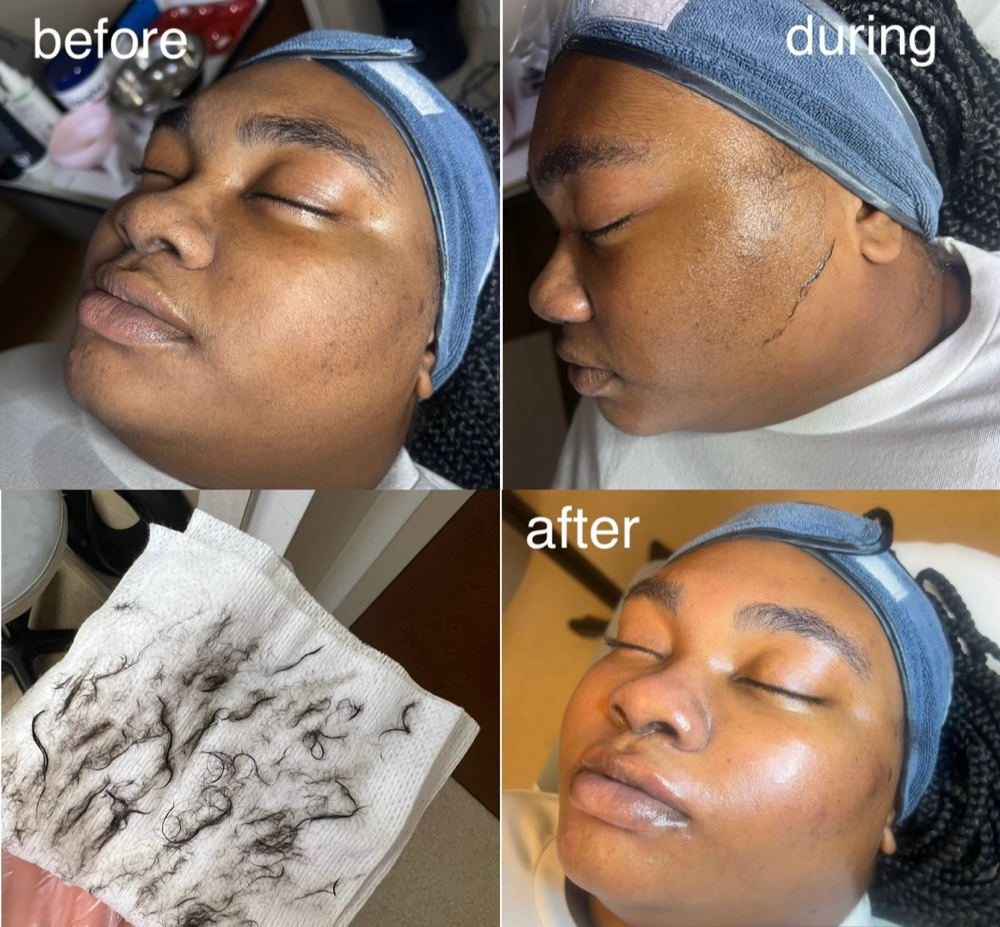 Dermaplane Facial With Halley