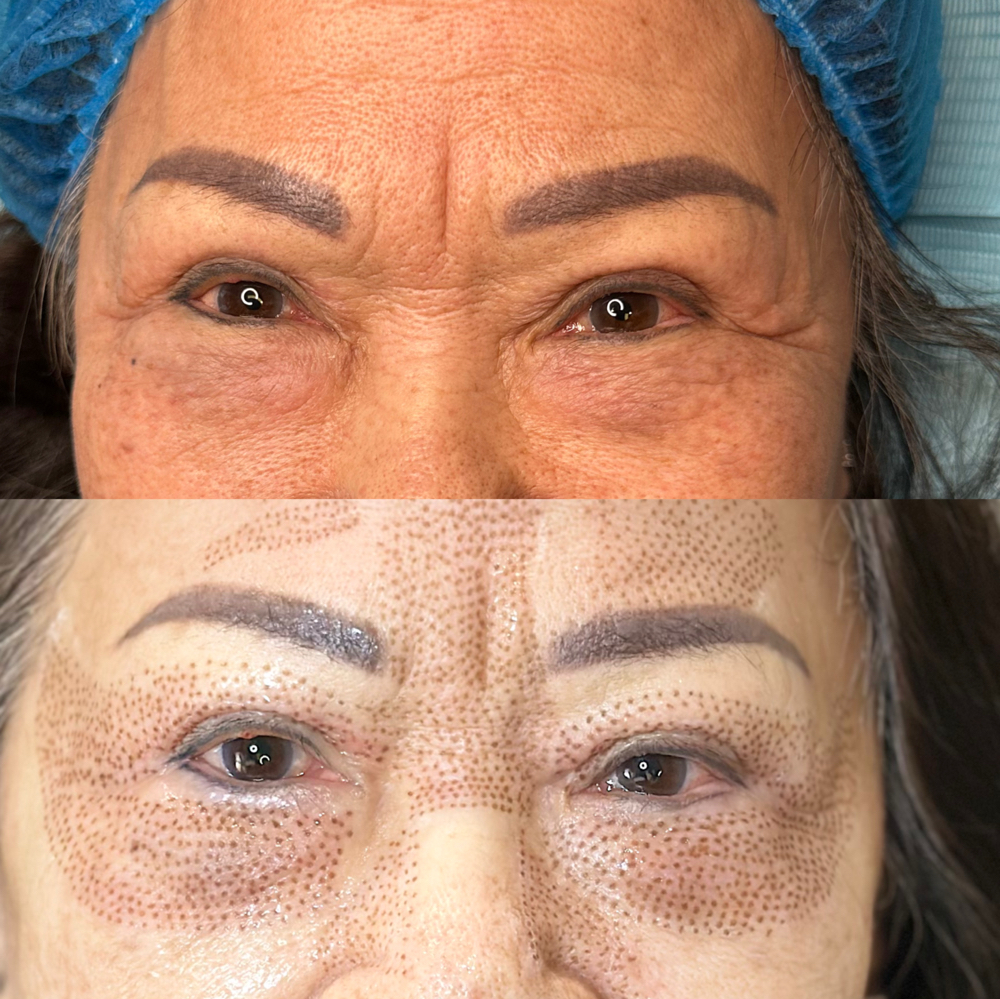 Lower Eyelids Lift