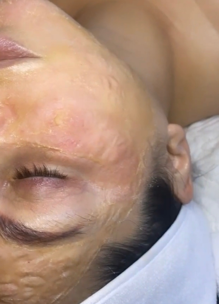 Collagen Lifting Facial