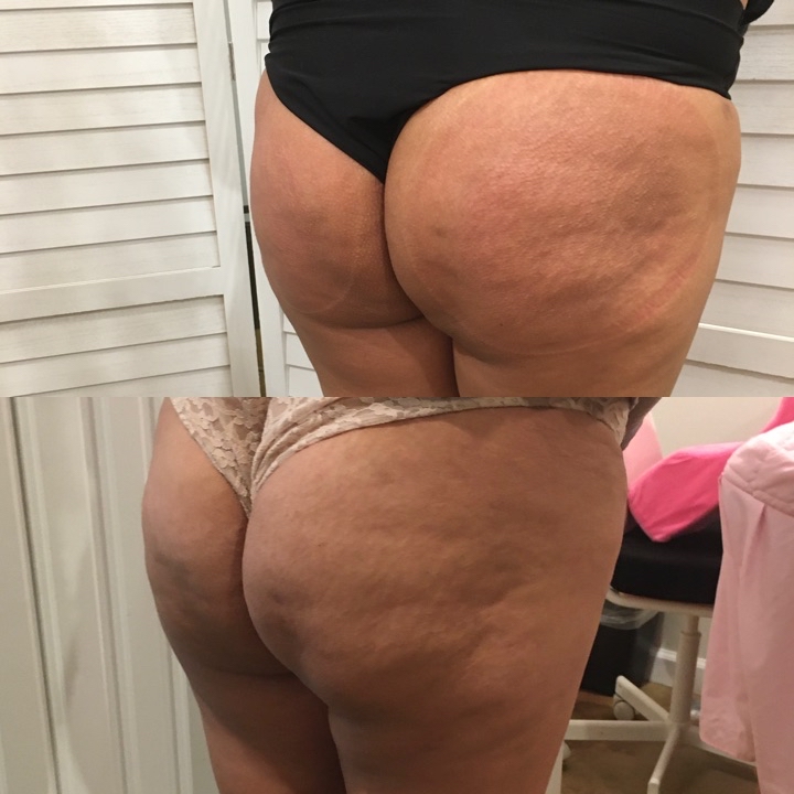 Booty Lift 6 Sessions