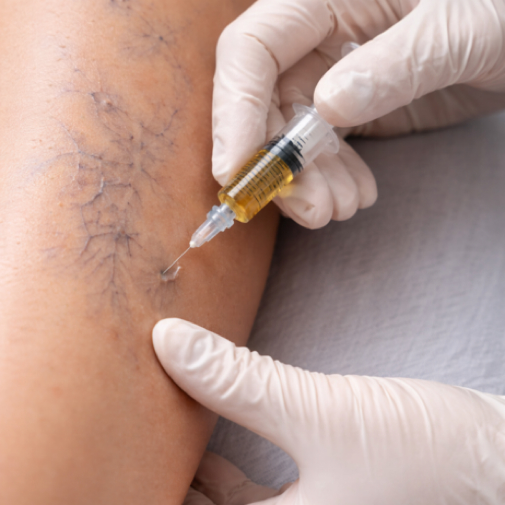 Escleroterapy /escleroterapia at Beauty Couture MedSpa in Austin, TX