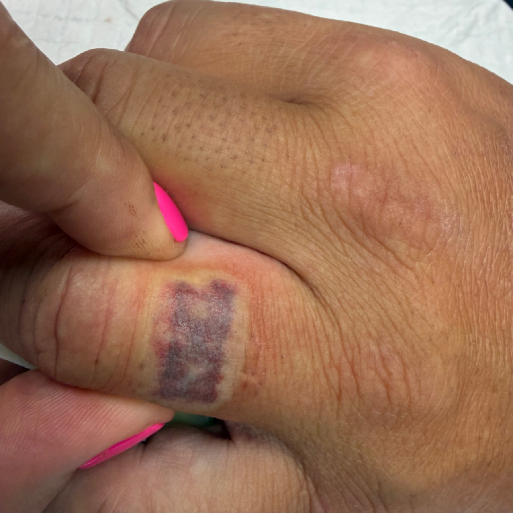 Saline Tattoo Removal at Flawless Skin By Sarah in Roseville, CA