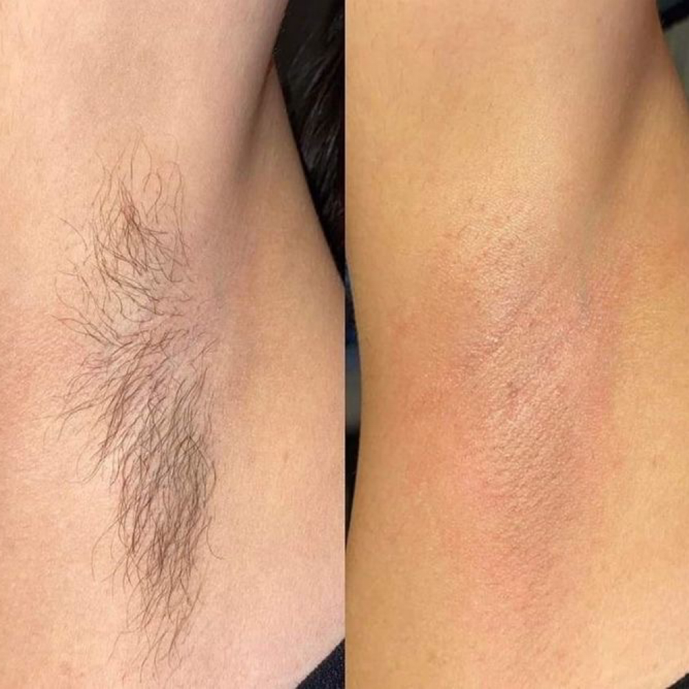Underarms at SKIN CLINIC in Laguna Hills, CA
