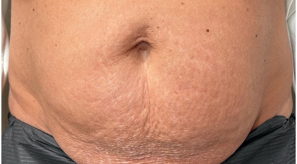 Full Tummy Stretch Mark And Tighten