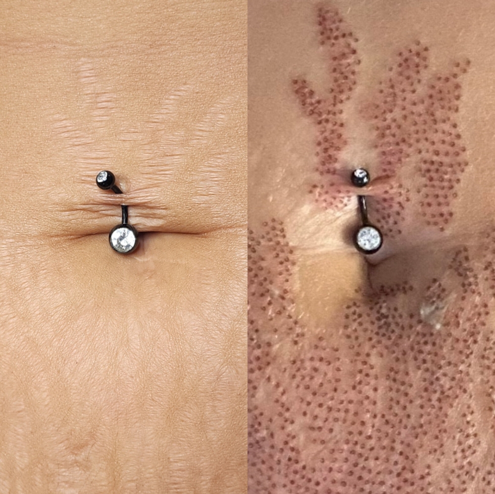 Stretchmark Reduction