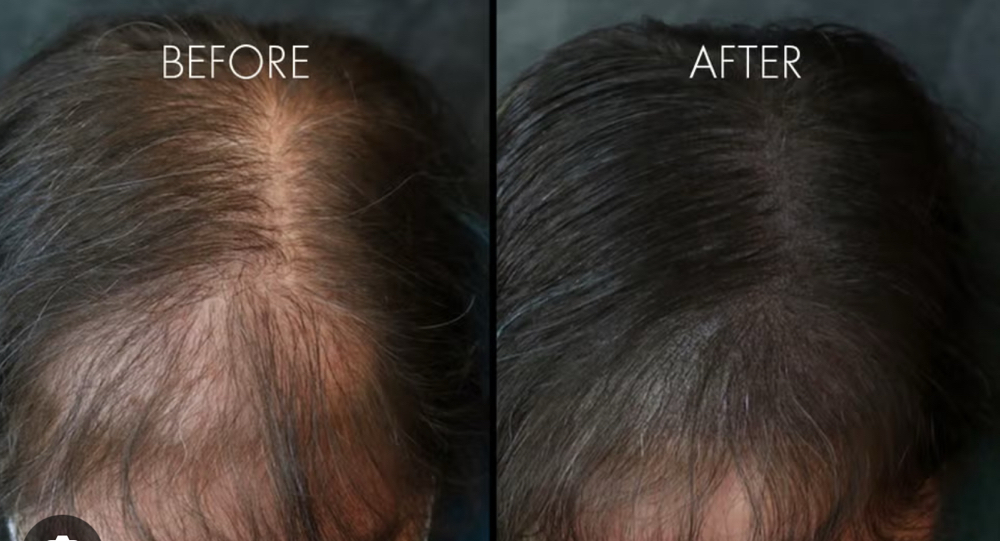 Hairline Micropigmentation50% off