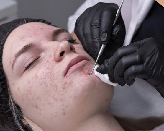 Acne Facial