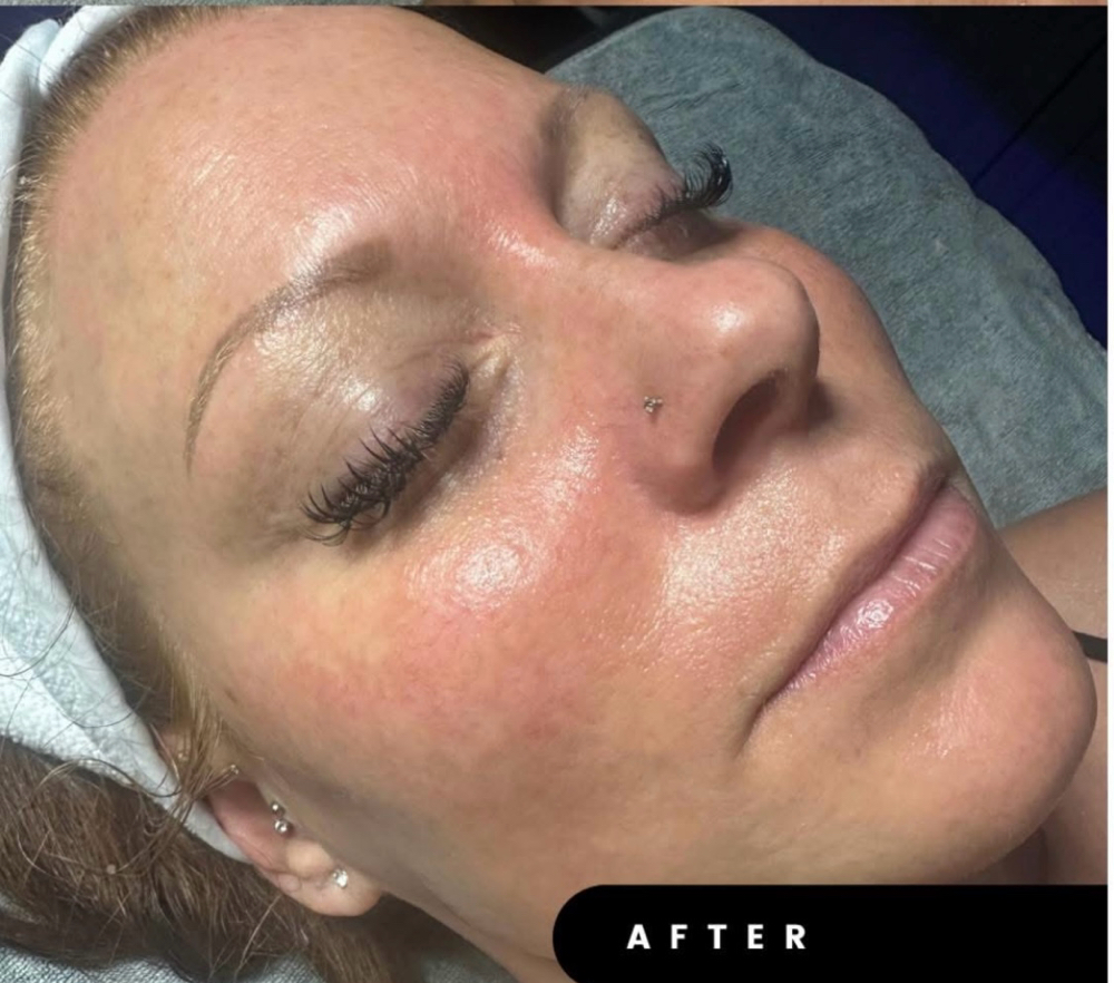 Beyond Botox Facial