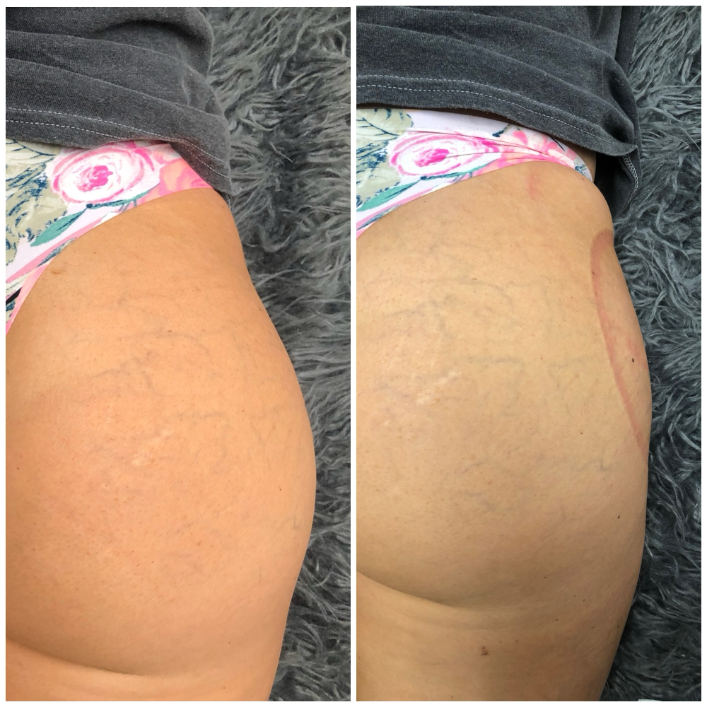 Hip Dip Correction at Babe And Bloom in Prescott, AZ