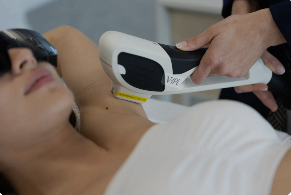 V-IPL Laser Hair Removal