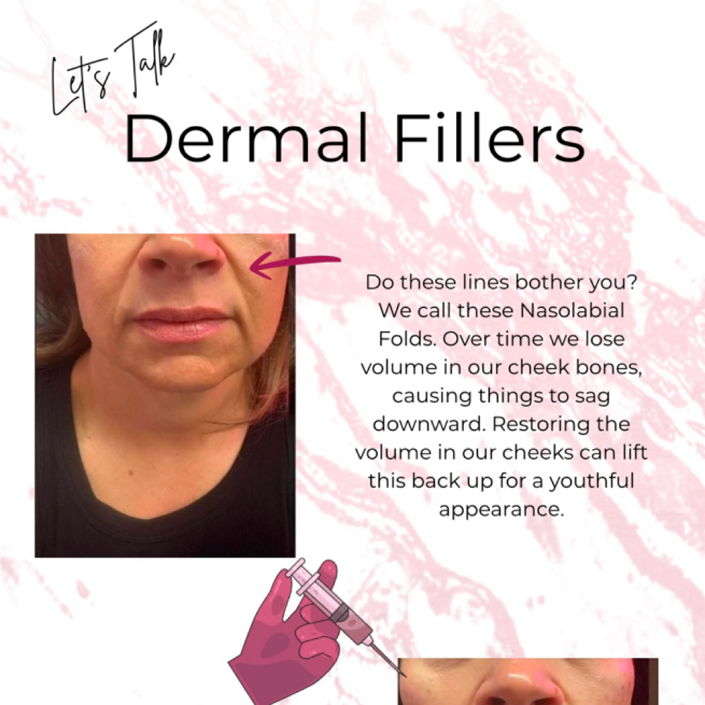 Dermal filler at Leann Renee Aesthetics in St. Peter's, MO
