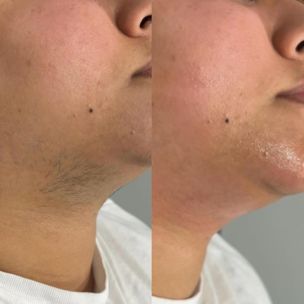 Chin at Divine Uplift Beauty in Upon Booking, NY