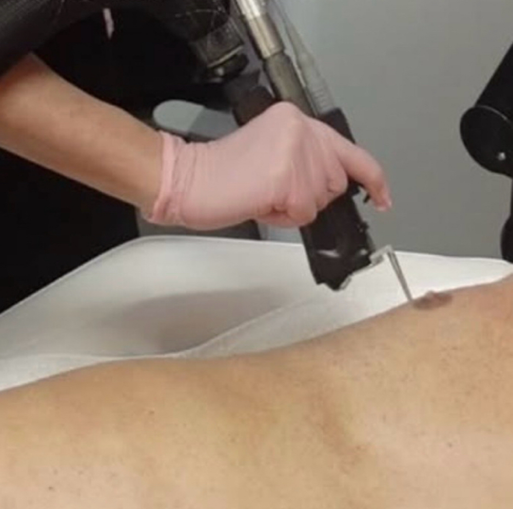 Laser Hair Removal- Chest at Erika’s Beauty Lab in Littleton, CO