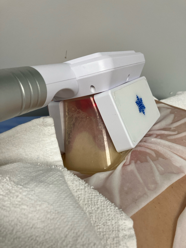 Cryolipolysis Consultation