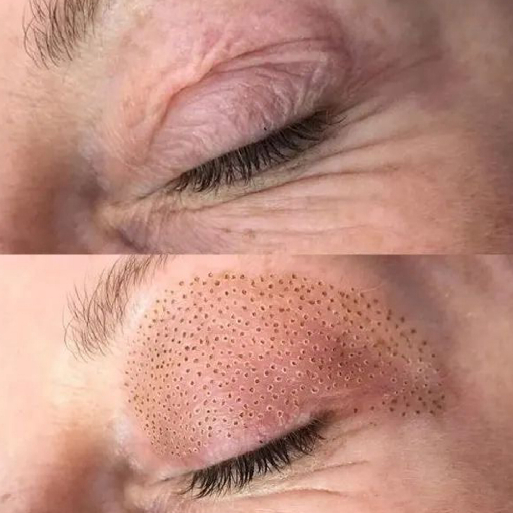Fibroblast Eyelid Lift Upper/Under at Glo’s Beauty Creations