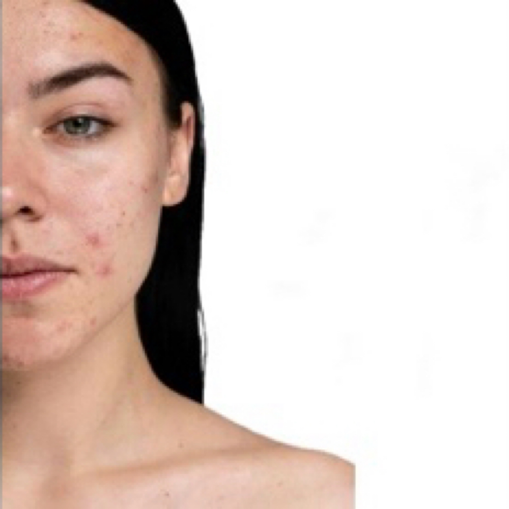 SERIES SCAR REVISION 5 SERIES at AESTHETICSBYNATALY in Alhambra, CA