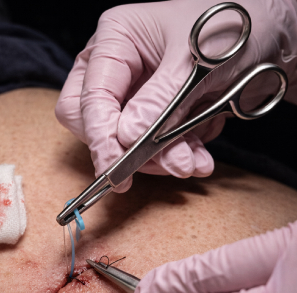 Surture/Drain Removal at Snatched X Stacey in Dallas, TX