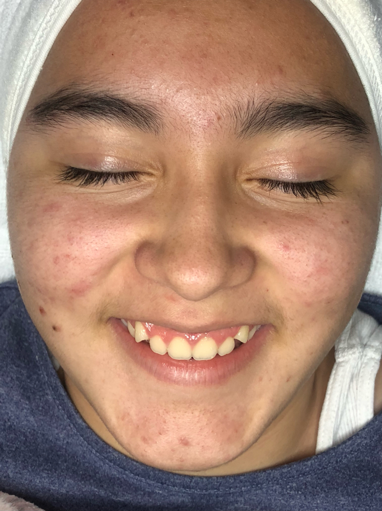Acne Teen Facial
