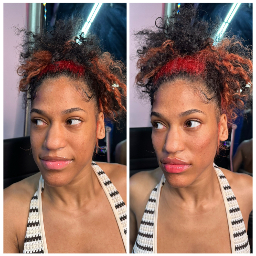 Cheek Filler at Pretty By Princess in Philadelphia, PA