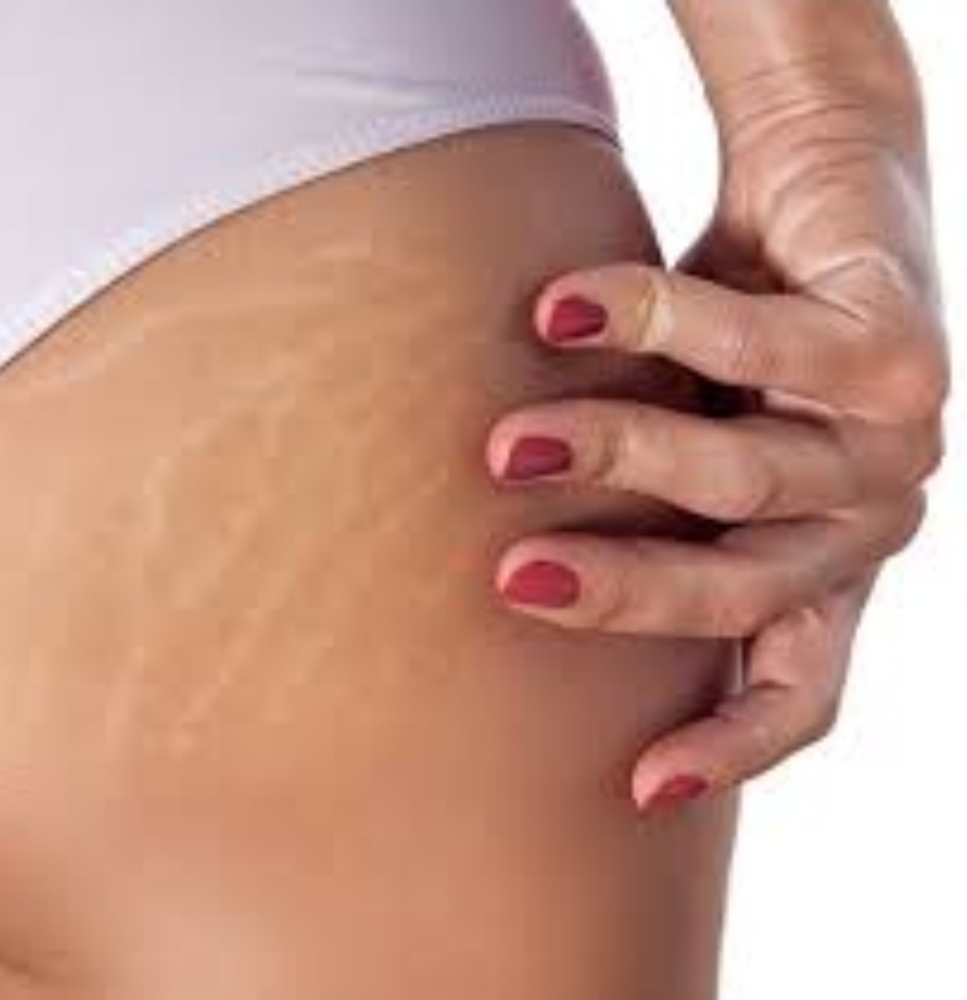 Stretch Mark Rejuvanation per area
