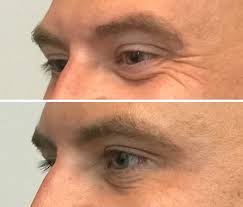 Crows Feet Tox