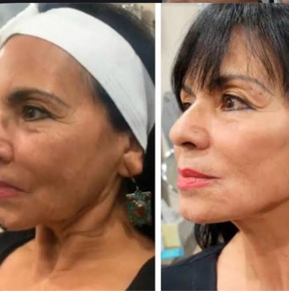 Nefertiti Lift Neck Lift with Botox at Flawless Spa & Beauty in Fort Worth, TX